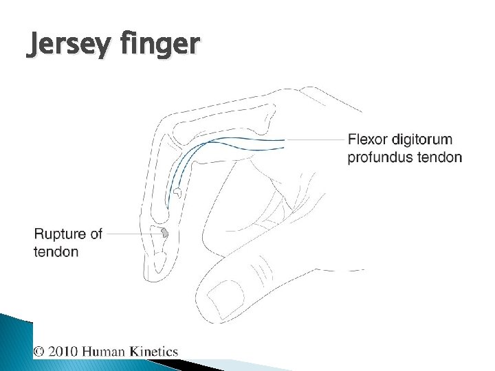 Jersey finger 