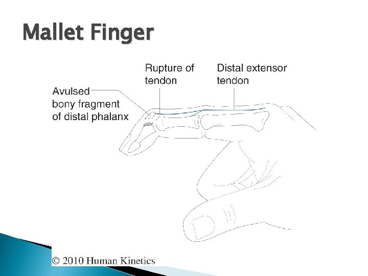 Mallet Finger 