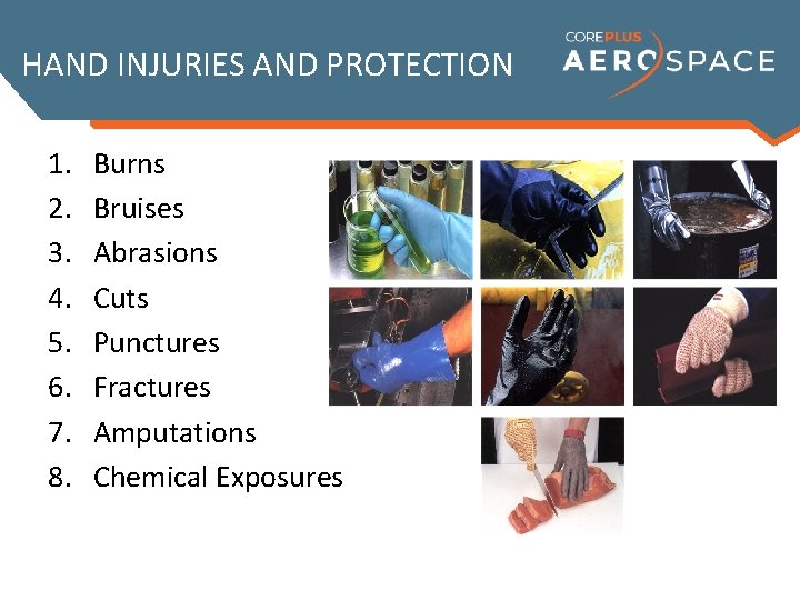 HAND INJURIES AND PROTECTION 1. 2. 3. 4. 5. 6. 7. 8. Burns Bruises