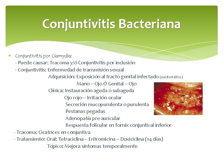 Conjuntivitis Bacteriana Conjuntivitis por Clamydia: - Puede causar: Tracoma y/ó Conjuntivitis por inclusión -