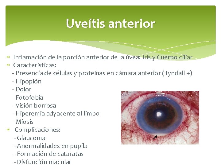 Uveítis anterior Inflamación de la porción anterior de la úvea: Iris y Cuerpo ciliar
