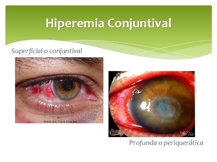 Hiperemia Conjuntival Superficial o conjuntival Profunda o periquerática 
