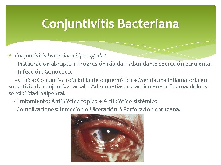 Conjuntivitis Bacteriana Conjuntivitis bacteriana hiperaguda: - Instauración abrupta + Progresión rápida + Abundante secreción