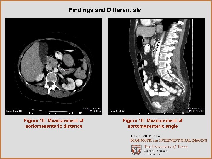 Findings and Differentials Figure 15: Measurement of aortomesenteric distance Figure 16: Measurement of aortomesenteric