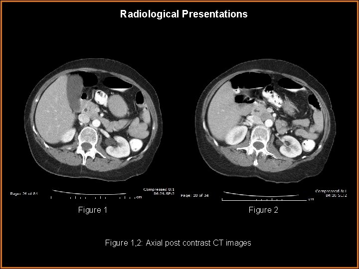 Radiological Presentations Figure 1 Figure 2 Figure 1, 2: Axial post contrast CT images