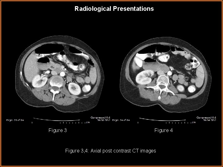 Radiological Presentations Figure 3 Figure 4 Figure 3, 4: Axial post contrast CT images