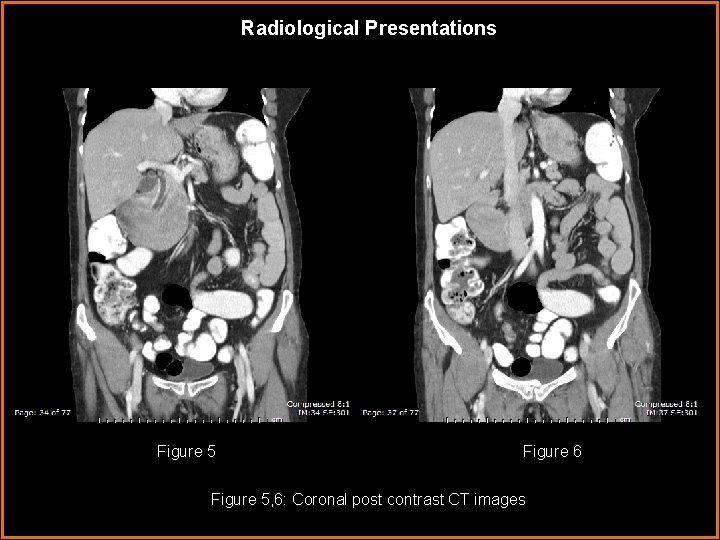 Radiological Presentations Figure 5 Figure 6 Figure 5, 6: Coronal post contrast CT images