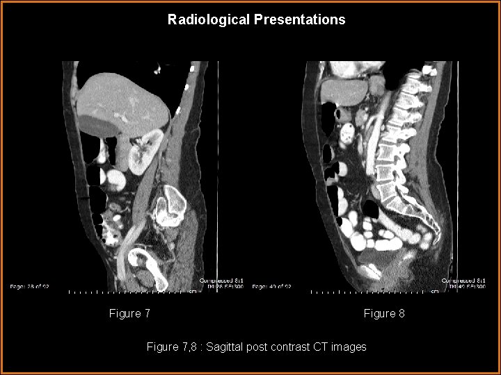 Radiological Presentations Figure 7 Figure 8 Figure 7, 8 : Sagittal post contrast CT