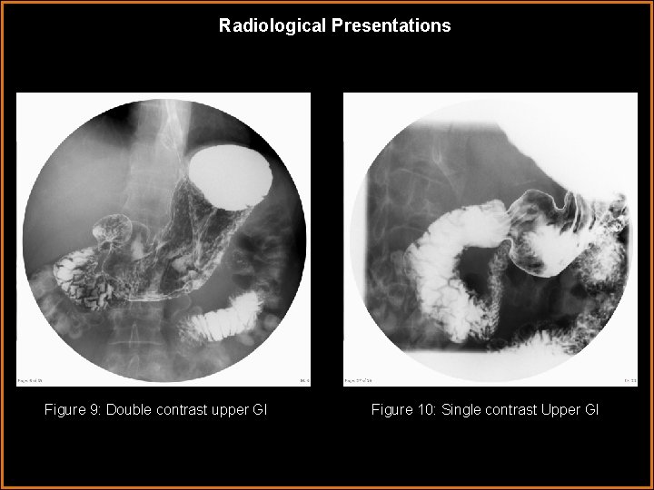Radiological Presentations Figure 9: Double contrast upper GI Figure 10: Single contrast Upper GI