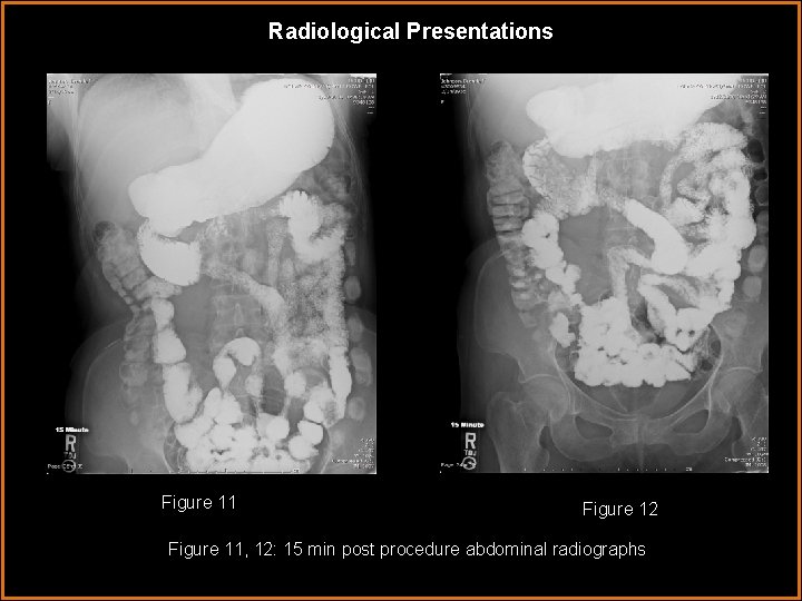 Radiological Presentations Figure 11 Figure 12 Figure 11, 12: 15 min post procedure abdominal