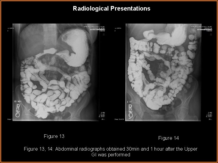 Radiological Presentations Figure 13 Figure 14 Figure 13, 14: Abdominal radiographs obtained 30 min