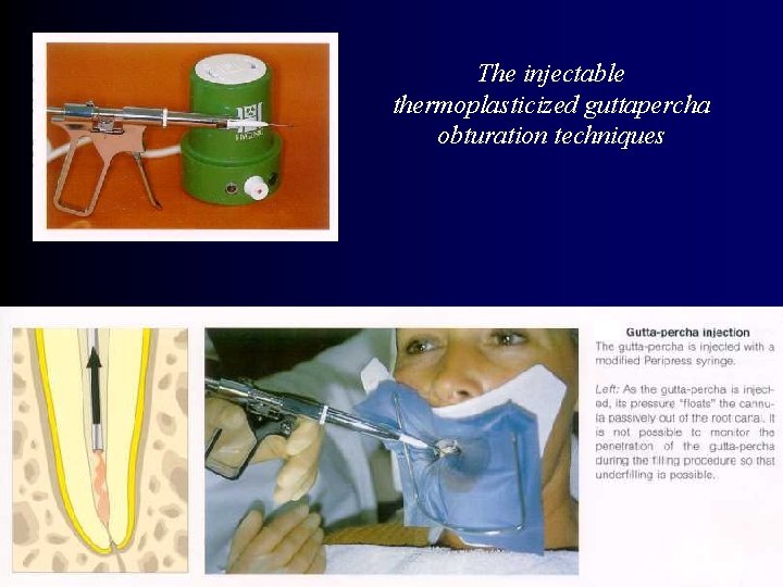 The injectable thermoplasticized guttapercha obturation techniques 