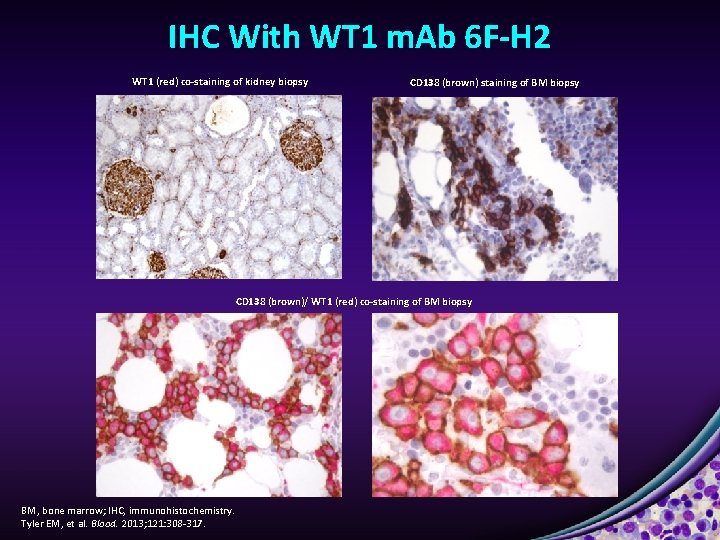 IHC With WT 1 m. Ab 6 F-H 2 WT 1 (red) co-staining of