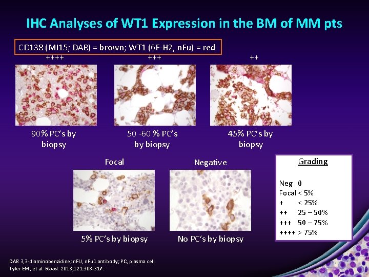 IHC Analyses of WT 1 Expression in the BM of MM pts CD 138