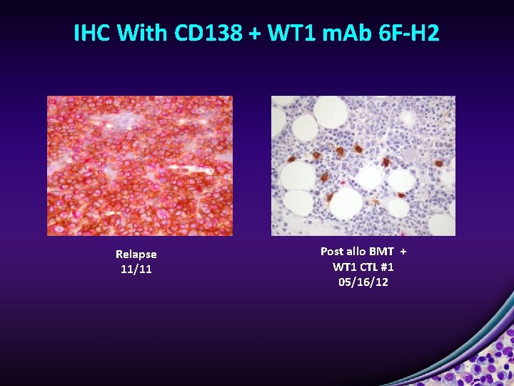 IHC With CD 138 + WT 1 m. Ab 6 F-H 2 Relapse 11/11