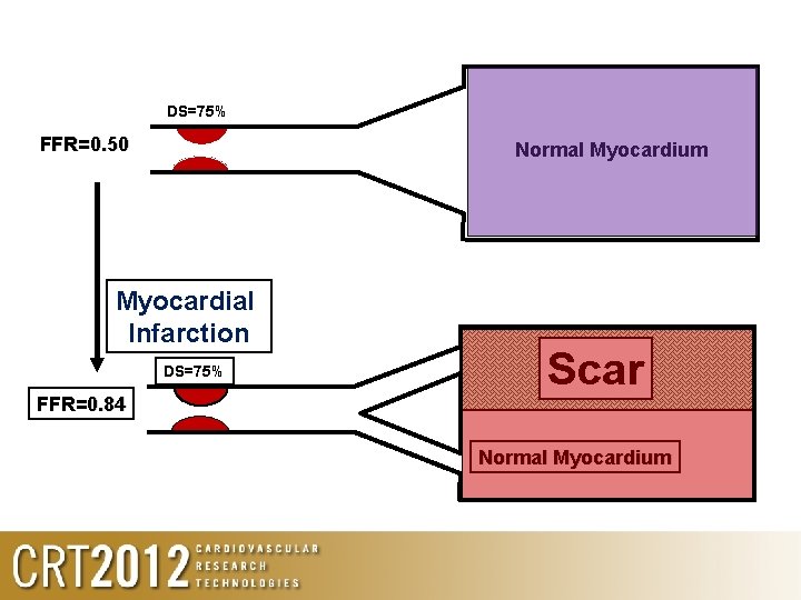 DS=75% FFR=0. 50 Normal Myocardium Myocardial Infarction DS=75% FFR=0. 84 Scar Normal Myocardium 