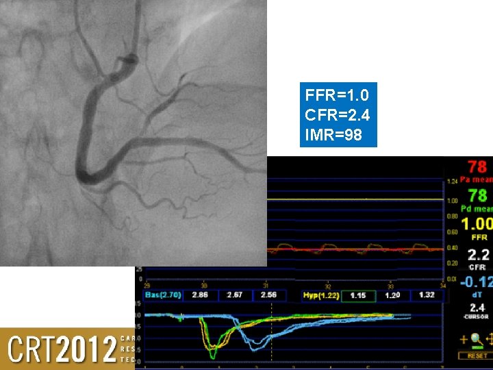 FFR=1. 0 CFR=2. 4 IMR=98 