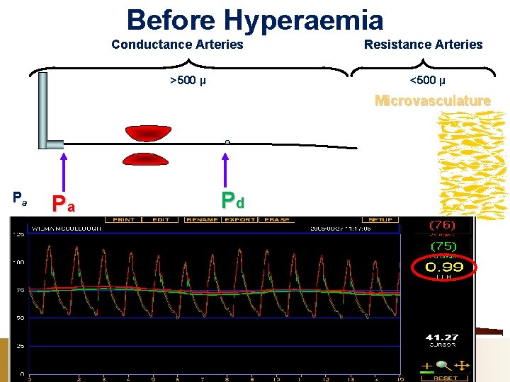 Before Hyperaemia Conductance Arteries >500 µ Resistance Arteries <500 µ Microvasculature Pa Pd Pa
