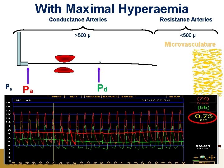With Maximal Hyperaemia Conductance Arteries >500 µ Resistance Arteries <500 µ Microvasculature Pa Pd