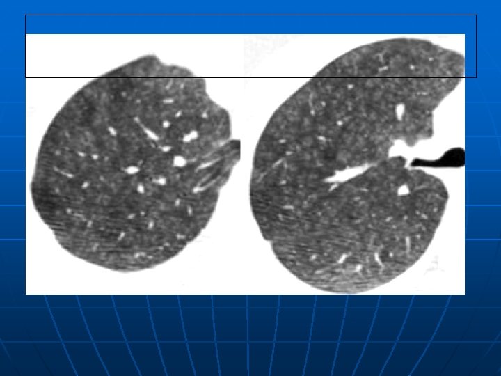 M 3 M 21 Focal Reticulonodular Patterns A