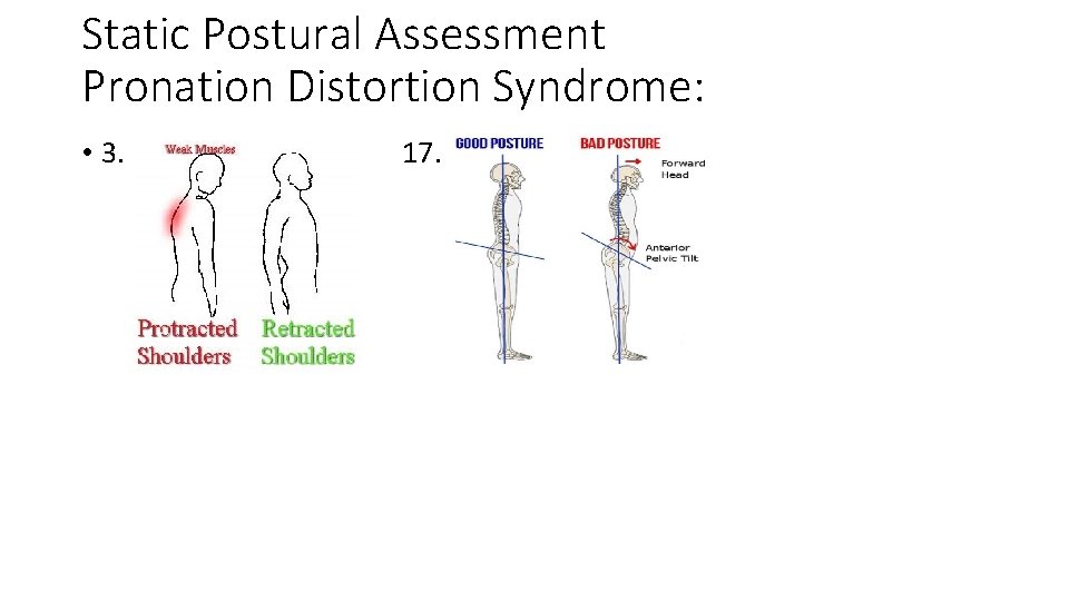 Static Postural Assessment Pronation Distortion Syndrome: • 3. 17. 