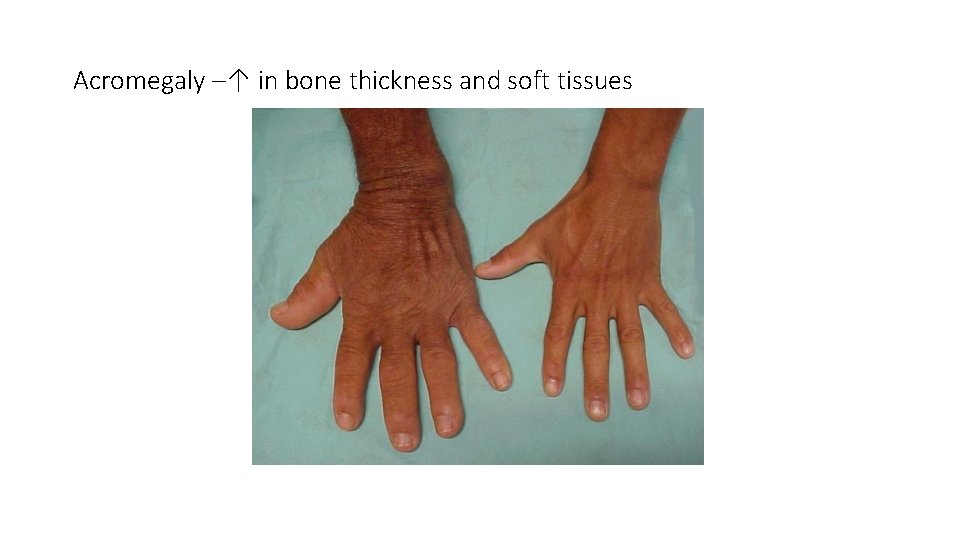 Acromegaly –↑ in bone thickness and soft tissues 