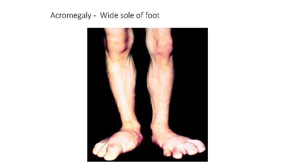 Acromegaly - Wide sole of foot 