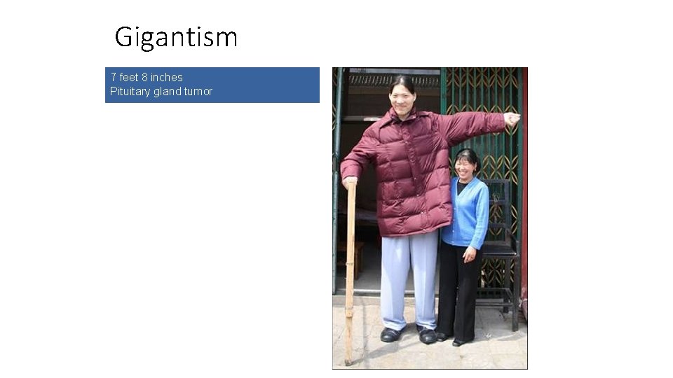 Gigantism 7 feet 8 inches Pituitary gland tumor 