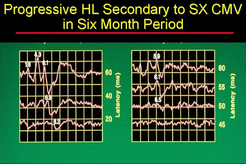 Progressive HL Secondary to SX CMV in Six Month Period 