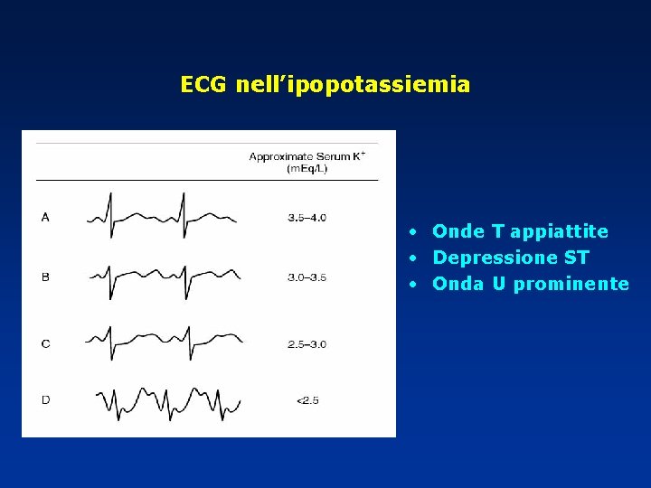 ECG nell’ipopotassiemia • Onde T appiattite • Depressione ST • Onda U prominente 