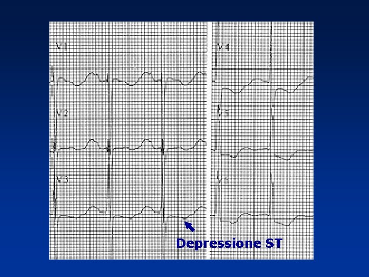 Depressione ST Depressione ST