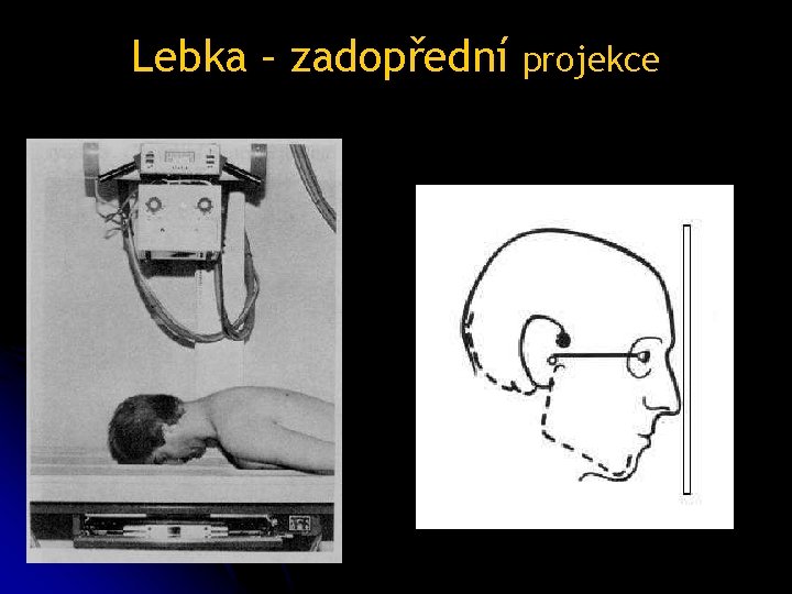 Lebka – zadopřední projekce 