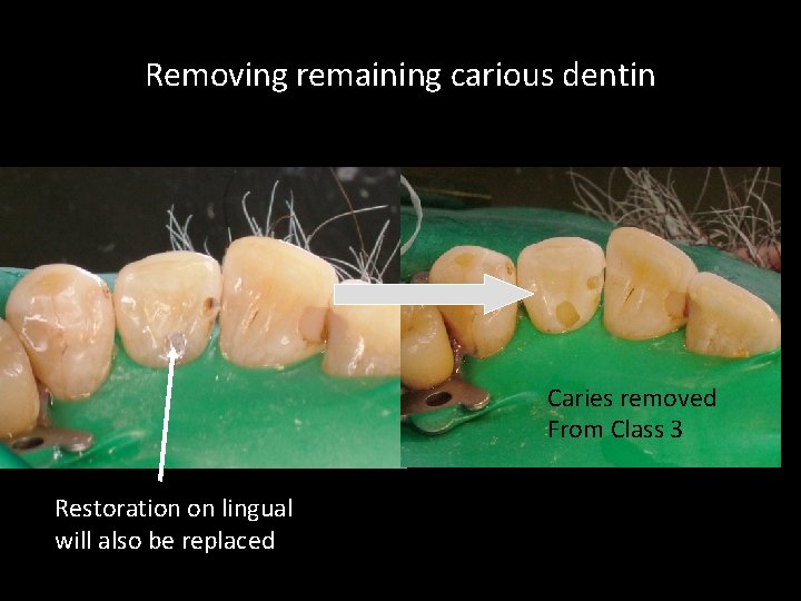 Removing remaining carious dentin Caries removed From Class 3 Restoration on lingual will also