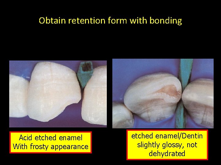 Obtain retention form with bonding Acid etched enamel With frosty appearance etched enamel/Dentin slightly