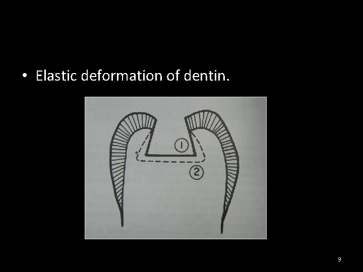  • Elastic deformation of dentin. 9 