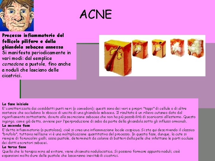 ACNE Processo infiammatorio del follicolo pilifero e della ghiandola sebacea annessa Si manifesta periodicamente ACNE Processo infiammatorio del follicolo pilifero e della ghiandola sebacea annessa Si manifesta periodicamente