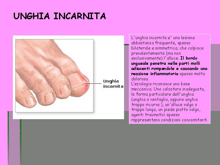 UNGHIA INCARNITA L'unghia incarnita e' una lesione abbastanza frequente, spesso bilaterale e simmetrica, che