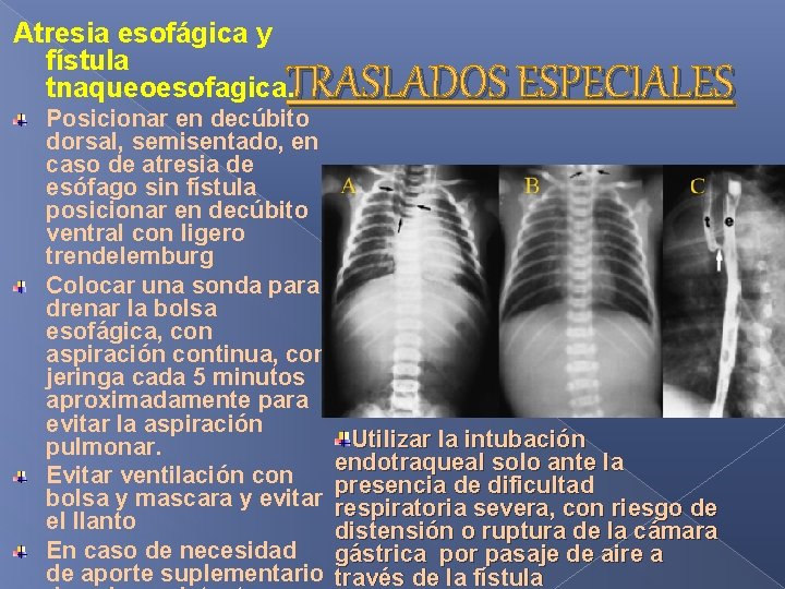 Atresia esofágica y fístula tnaqueoesofagica. TRASLADOS ESPECIALES Posicionar en decúbito dorsal, semisentado, en caso