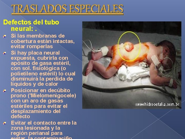 TRASLADOS ESPECIALES Defectos del tubo neural: . Si las membranas de cobertura están intactas, TRASLADOS ESPECIALES Defectos del tubo neural: . Si las membranas de cobertura están intactas,
