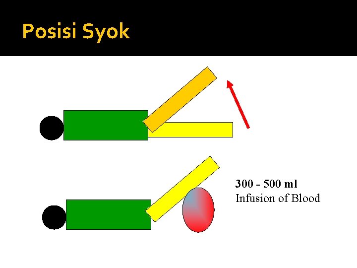 Posisi Syok 300 - 500 ml Infusion of Blood 