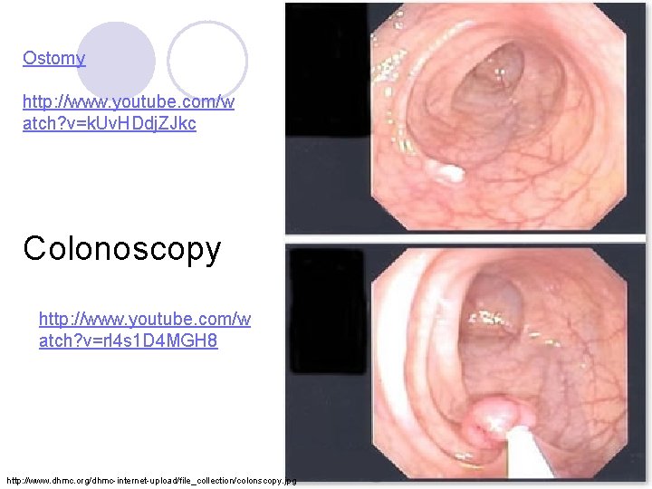 Ostomy http: //www. youtube. com/w atch? v=k. Uv. HDdj. ZJkc Colonoscopy http: //www. youtube.