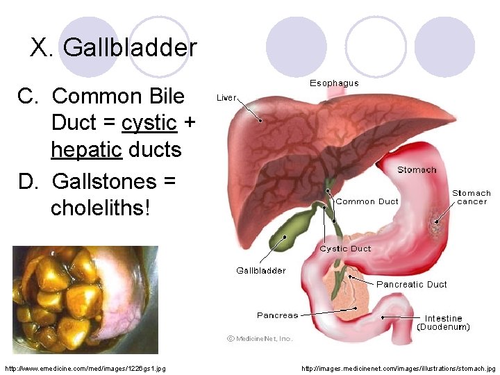 X. Gallbladder C. Common Bile Duct = cystic + hepatic ducts D. Gallstones =