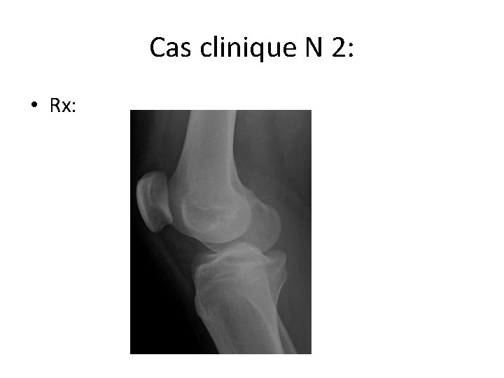 Cas clinique N 2: • Rx: 