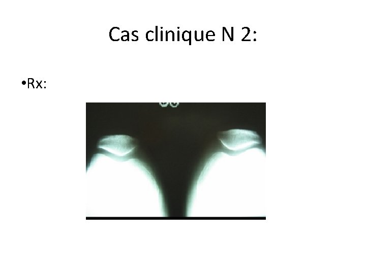 Cas clinique N 2: • Rx: 