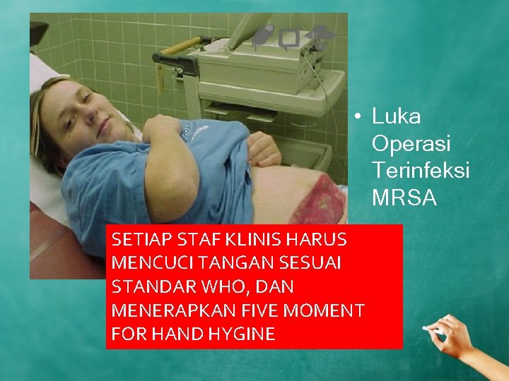  • Luka Operasi Terinfeksi MRSA SETIAP STAF KLINIS HARUS MENCUCI TANGAN SESUAI STANDAR