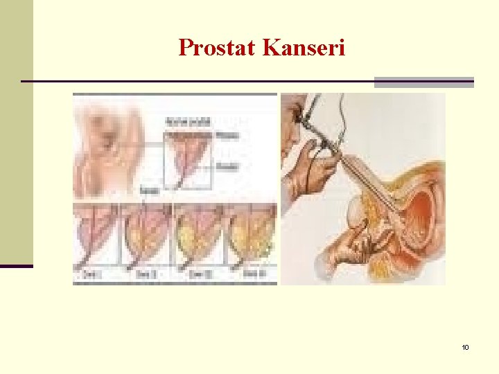 Prostat Kanseri 10 