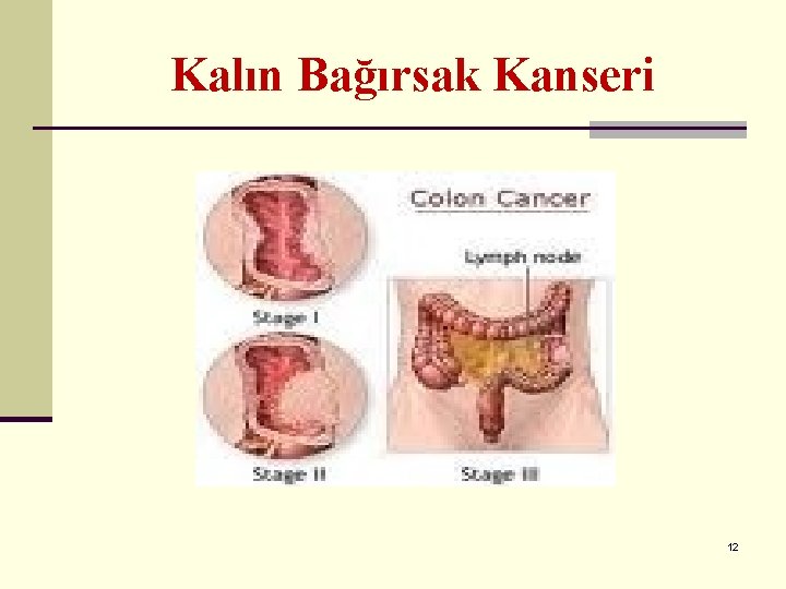 Kalın Bağırsak Kanseri 12 