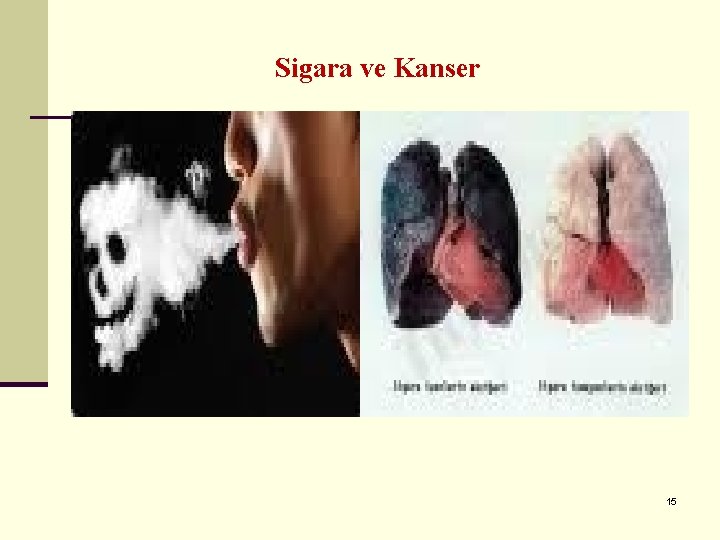 Sigara ve Kanser 15 