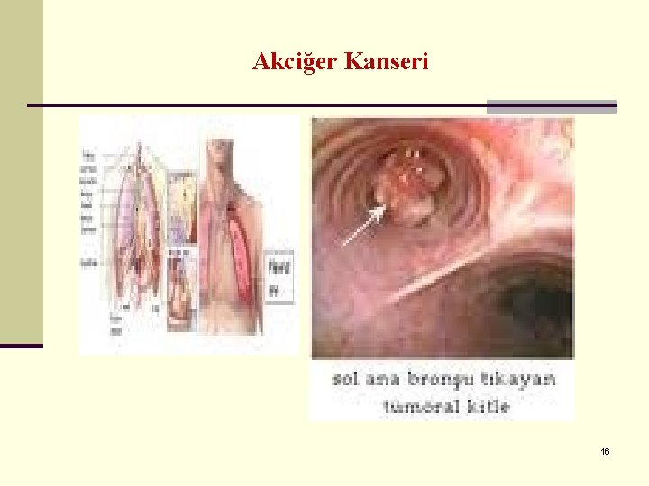 Akciğer Kanseri 16 