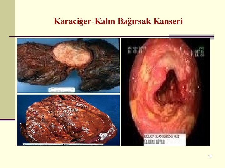 Karaciğer-Kalın Bağırsak Kanseri 18 